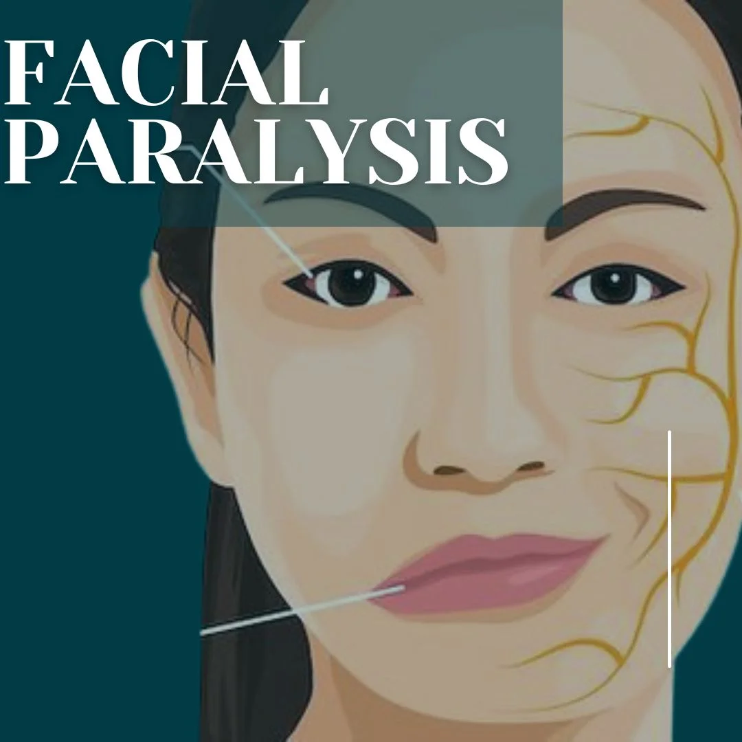 Facial paralysis stress